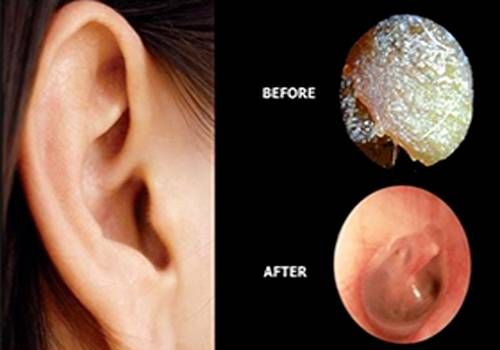Ear microsuction_before_after