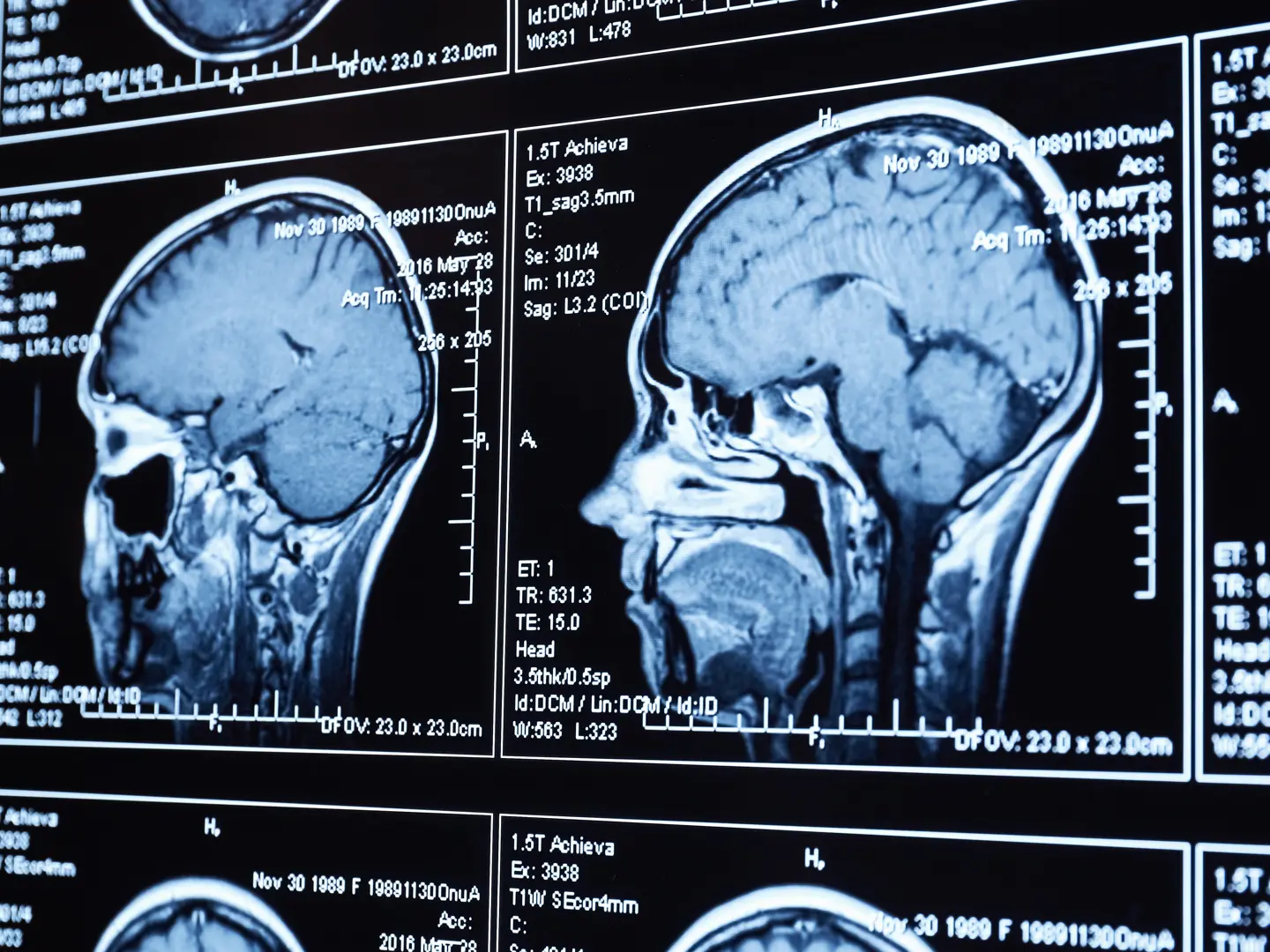 MRI Head Scan