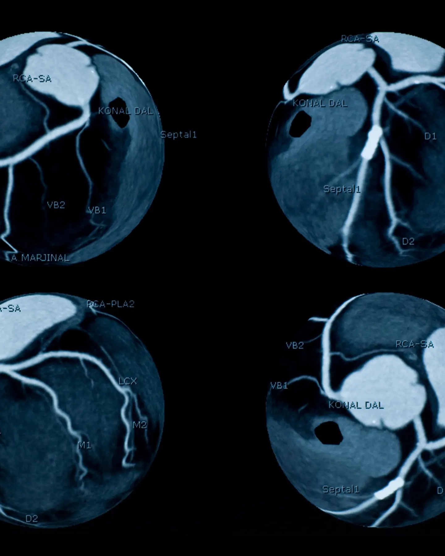 Cardiac CT Scan