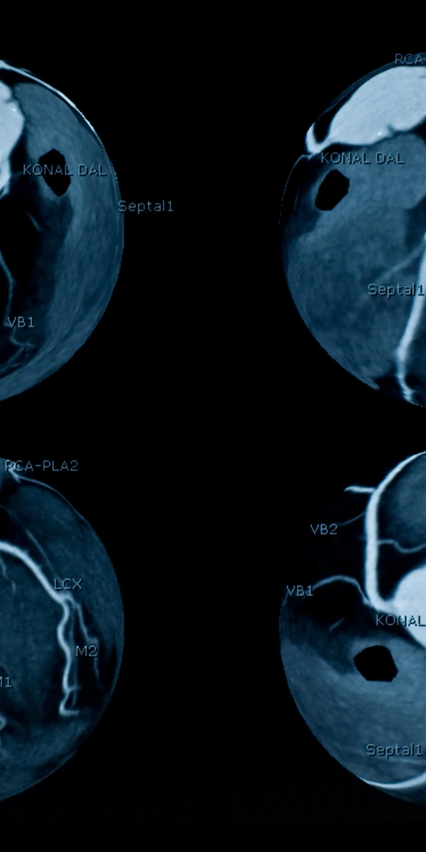 Cardiac CT Scan