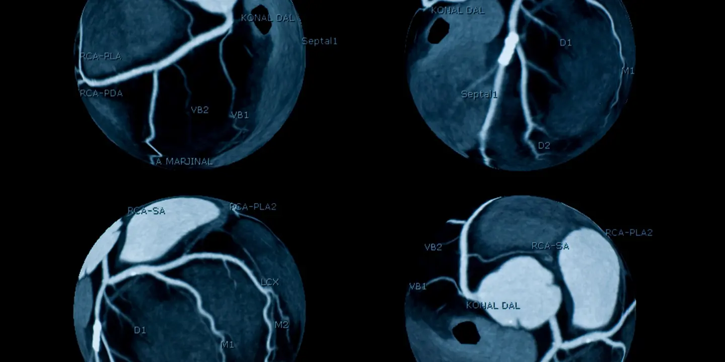 Cardiac CT Scan