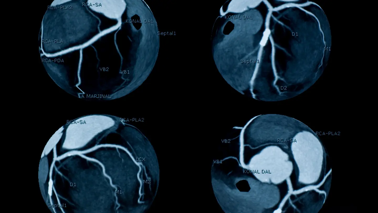 Cardiac CT Scan
