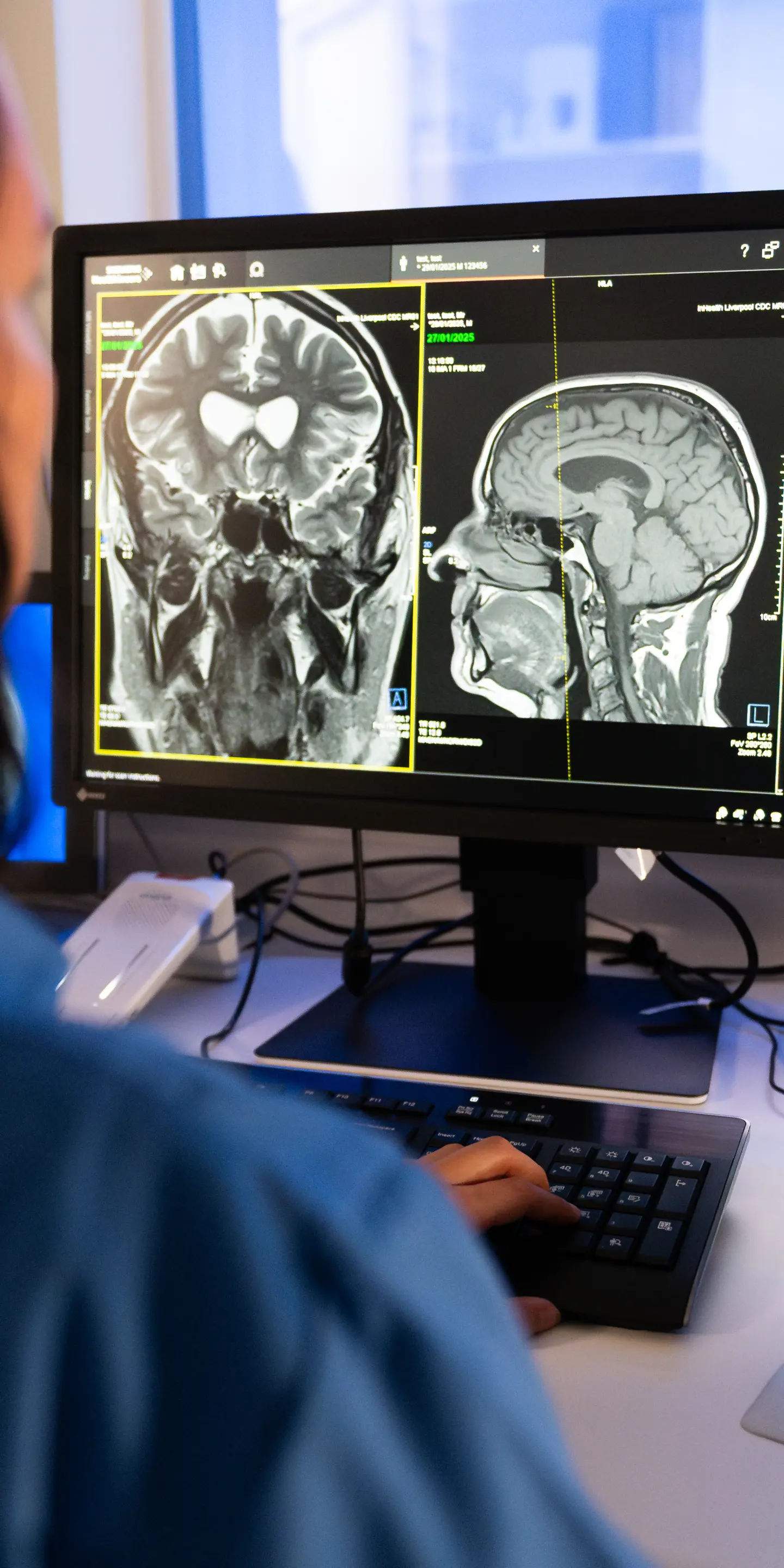 MRI Head