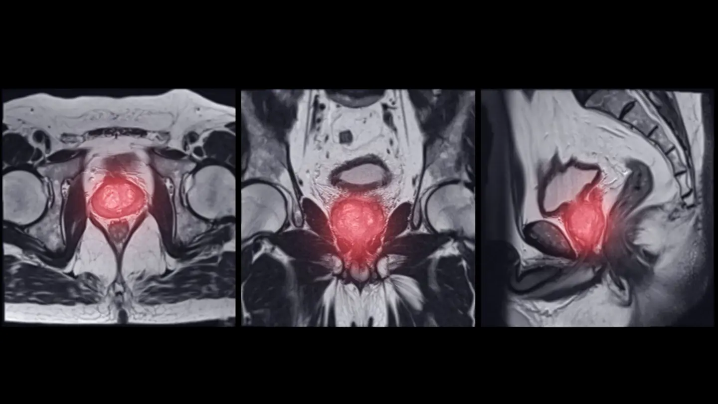 Prostate Scanner Private Prostate MRI Scan | Cancer Screening | Vista Health