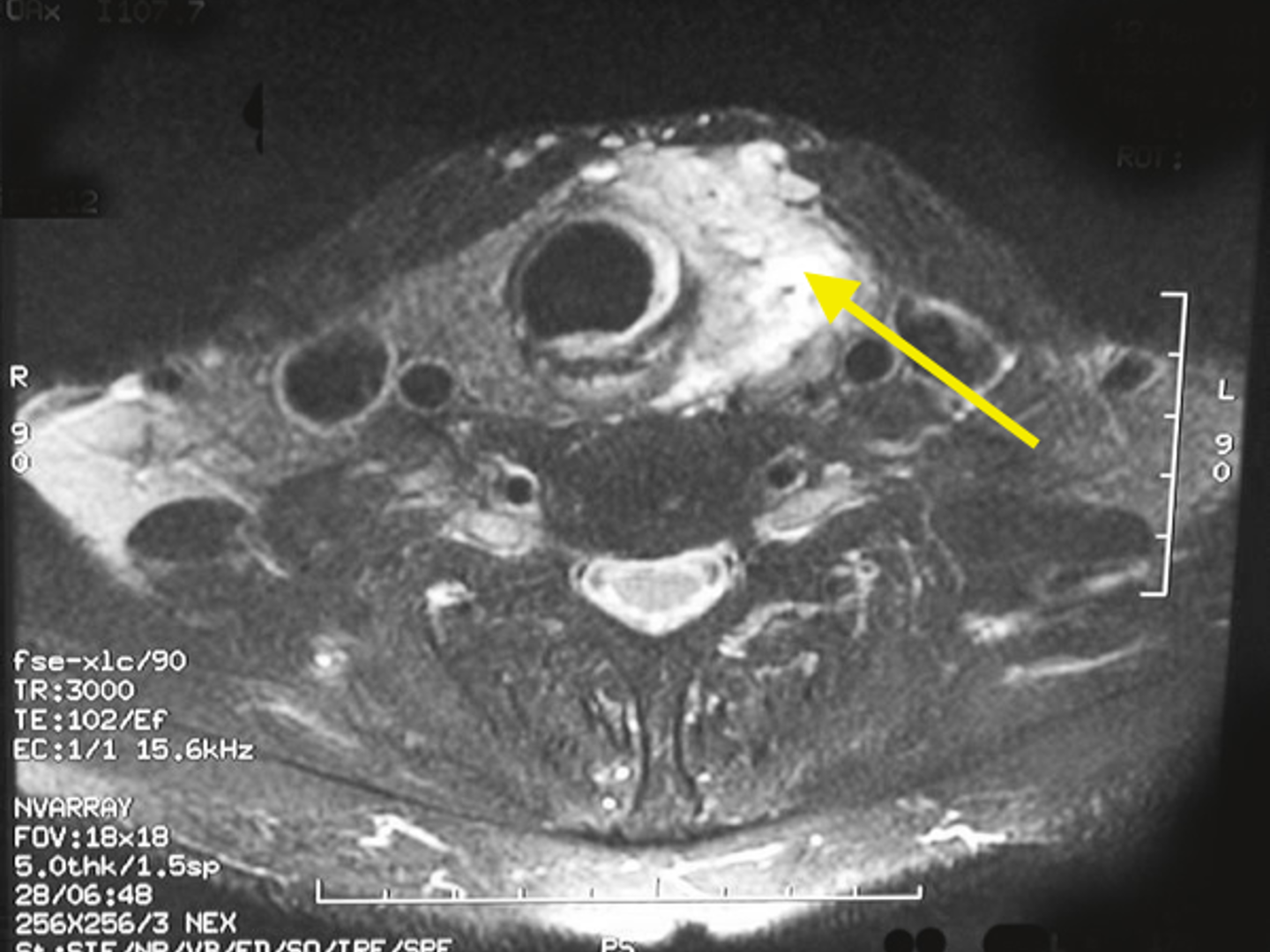Thyroid